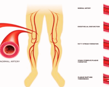 7 Natural Ways to Clear Your Arteries – No Pills, Just Results!