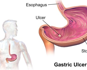 4 Natural Treatments for Stomach Ulcers Backed by Science That Could Change Your Life